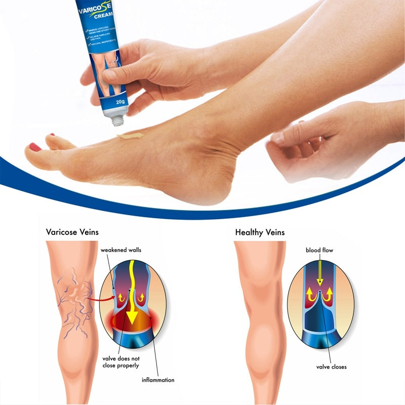 Varicose Veins Treatment Ointment Cream Relief Veins Pain